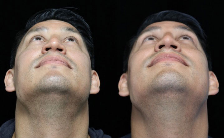 Before and after photo of a male patient with a refined nose tip