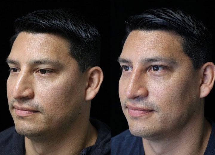 Photo of a male patient slightly facing right after a dorsal hump rhinoplasty