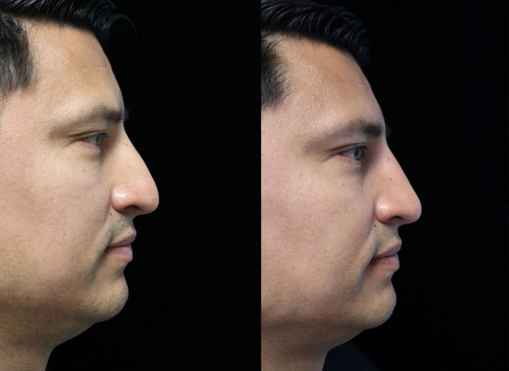 A man who underwent a dorsal hump nose job facing left