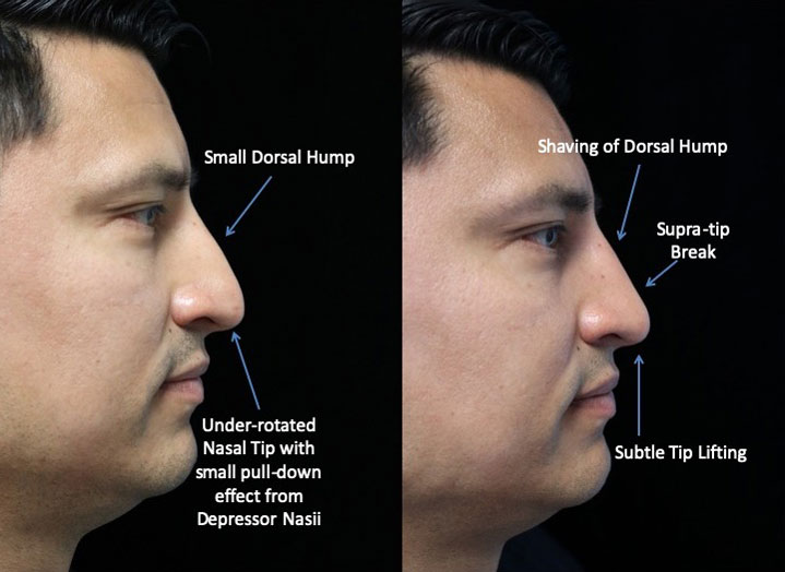 A man who underwent a dorsal hump reduction facing left