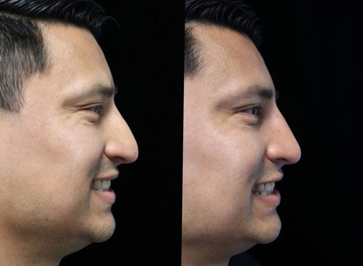 Before and after photo of a man who underwent a dorsal hump reduction