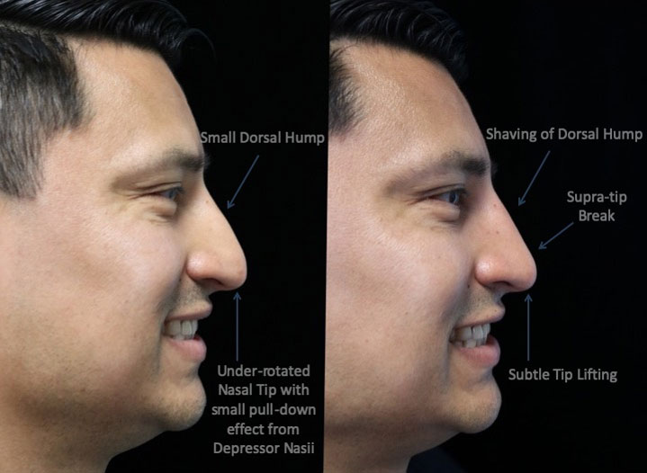 Photo of a male patient facing left with a small dorsal hump after rhinoplasty