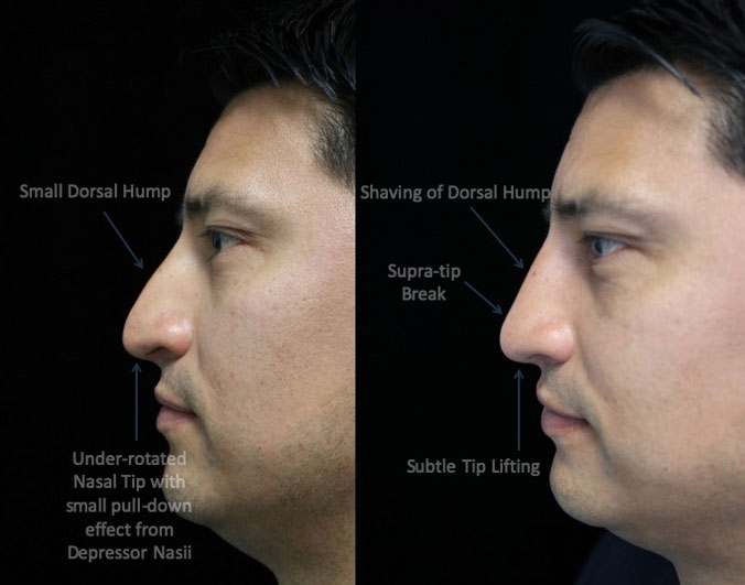 Photo of a male patient facing right with a small dorsal hump after rhinoplasty
