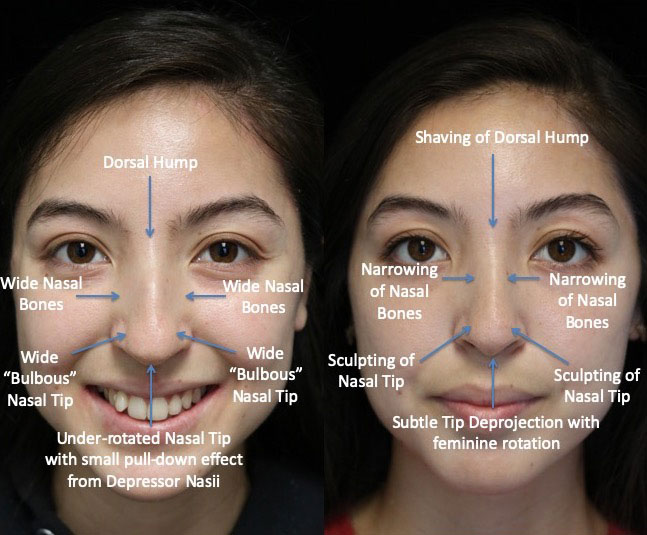 A female patient with the wide nasal bones after a wide nose rhinoplasty