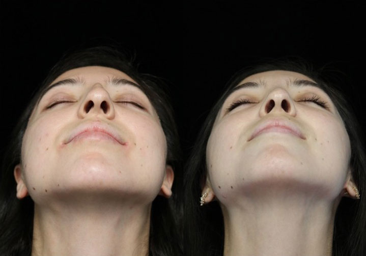 Before and after photo of a female patient with a refined nose tip