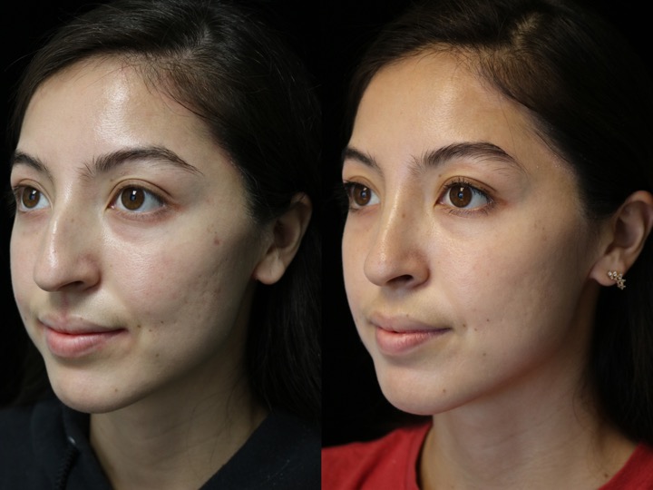 A female patient with a dorsal hump nose before and after surgery photo slightly facing right