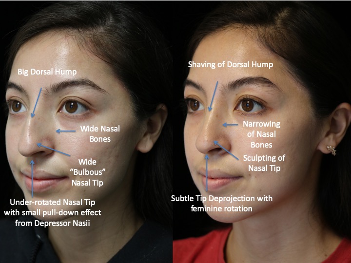 A female patient with a dorsal hump nose before and after surgery photo slightly facing right