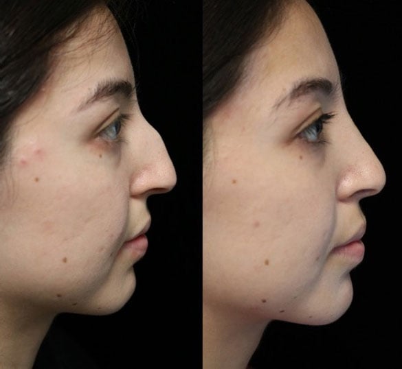 Big dorsal hump removal before and after photo of a female patient facing right
