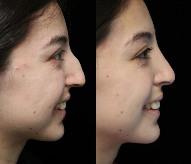 A female patient with a dorsal hump nose before and after surgery photo facing right