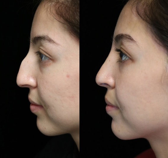 A female patient with a dorsal hump nose before and after surgery photo facing left
