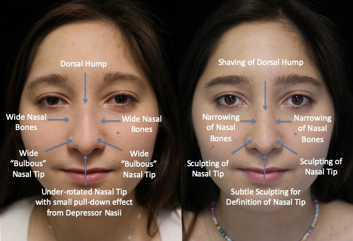 before and after photo of a woman with wide nasal bones who underwent rhinoplasty