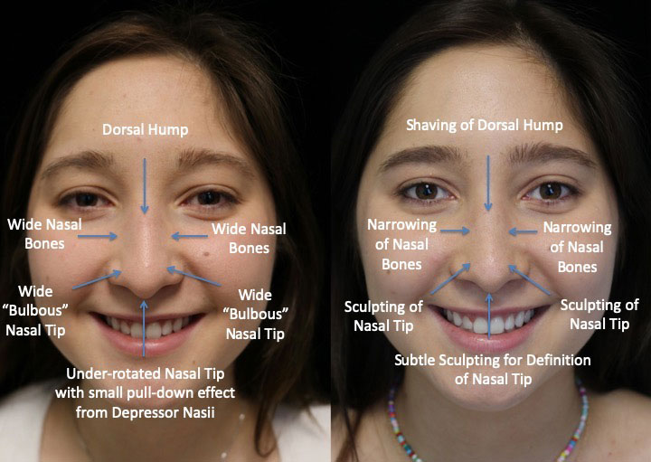 front view dorsal hump before and after photo of a woman