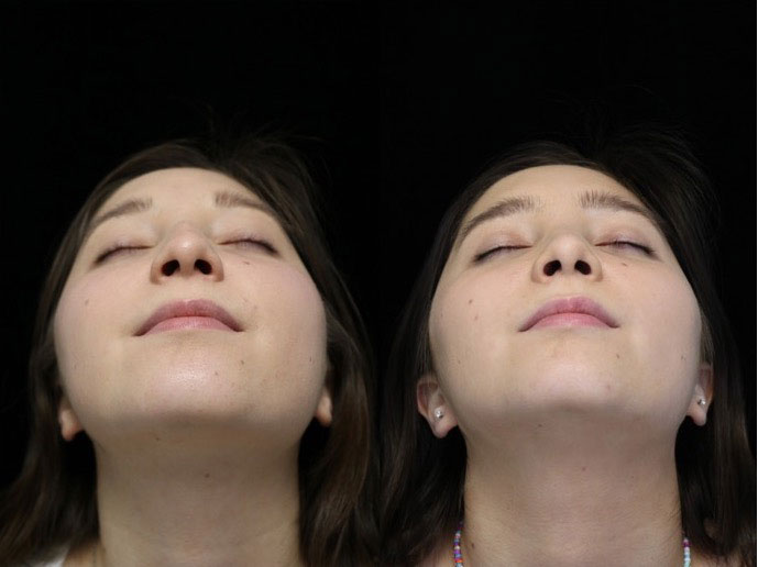 rhinoplasty before and after photo with no change on tip-nostril complex