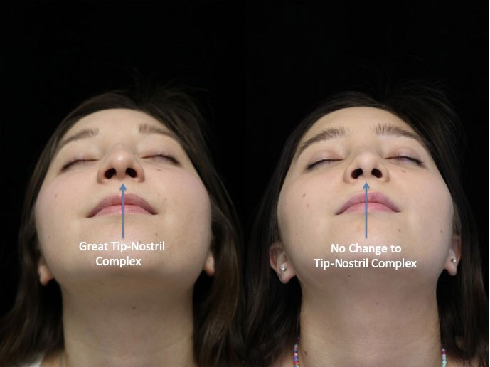 nose job dorsal hump before and after photo with no change to tip-nostril complex