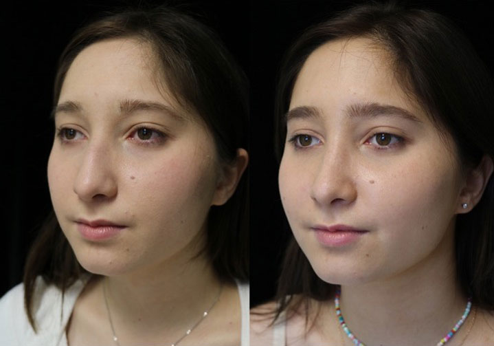 Before and after photo of female patient who underwent a dorsal hump nose job