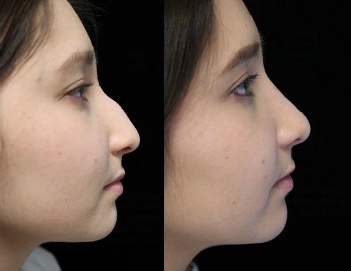 A female patient after a dorsal hump rhinoplasty