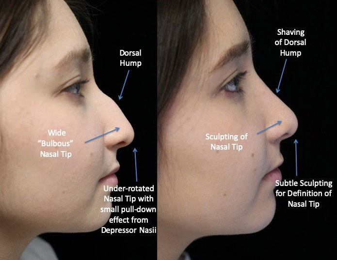 Photo of a female patient facing left after a dorsal hump rhinoplasty