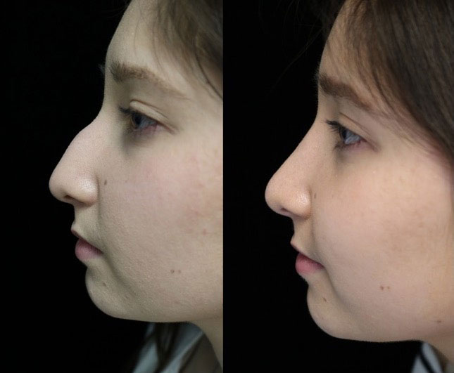 Photo of a female patient facing right after a dorsal hump rhinoplasty