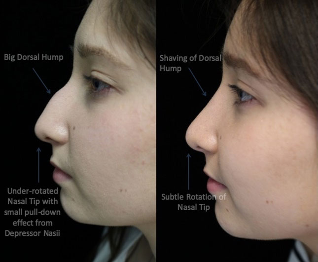A female patient with a big dorsal hump after a scarless rhinoplasty