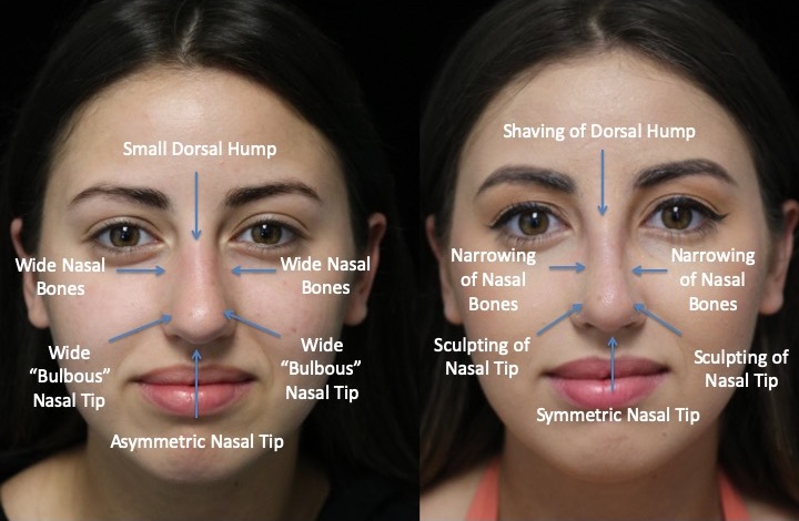 Before and after photo of a female patient with a narrowed nasal bones after nasal bone rhinoplasty