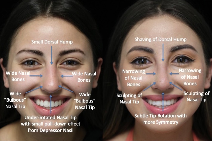 Before and after surgery photo of a female patient with a dorsal hump nose