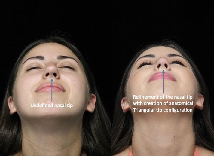 Before and after photo of a female patient who underwent a nasal tip refinement