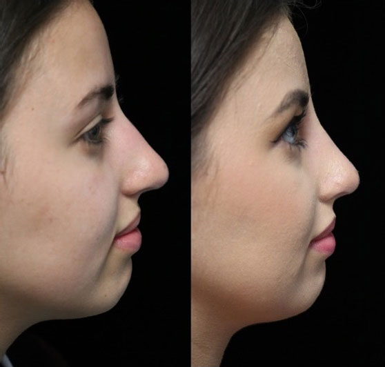 Photo of a woman with a dorsal hump nose facing right