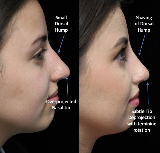 rhinoplasty before and after dorsal hump of a female patient