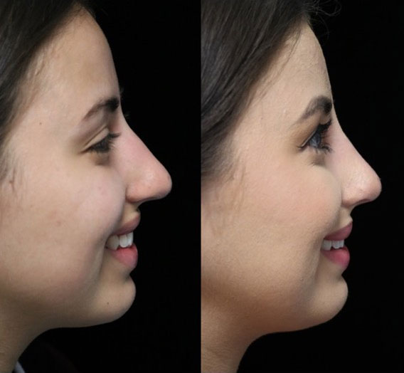 Before and after photo of a woman with a dorsal hump nose facing right