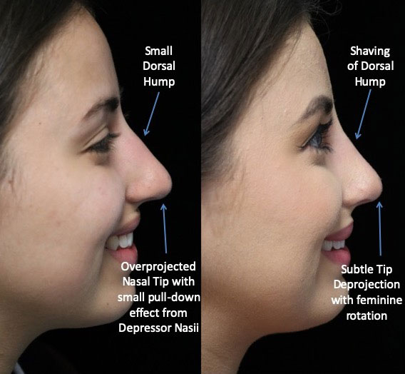 Before and after photo of a woman who underwent a dorsal hump nose job surgery