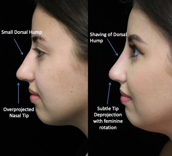 A woman with a dorsal hump nose who underwent a dorsal hump reduction