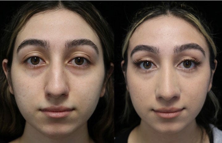 Before and afrer photo of a woman with a dorsal hump nose who underwent a dorsal hump reduction