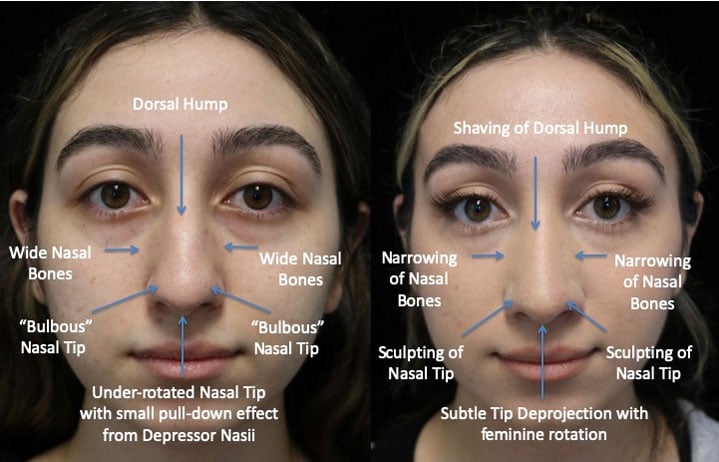 Before and afrer photo of a woman with a dorsal hump nose