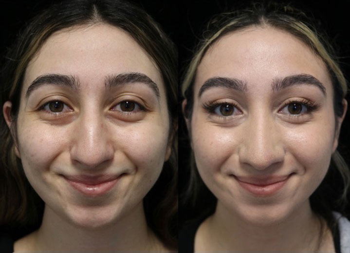 nose job dorsal hump before and after photo of a female patient