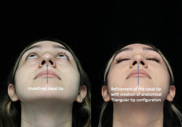 Before and after photo of a woman with an undefined nasal tip who underwent nose tip surgery