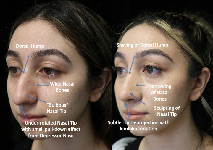 Before and after photo of a woman who underwent a hump removal rhinoplasty
