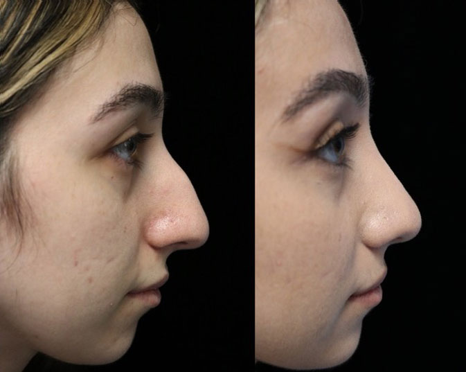 Photo of a female patient after a dorsal hump nose removal