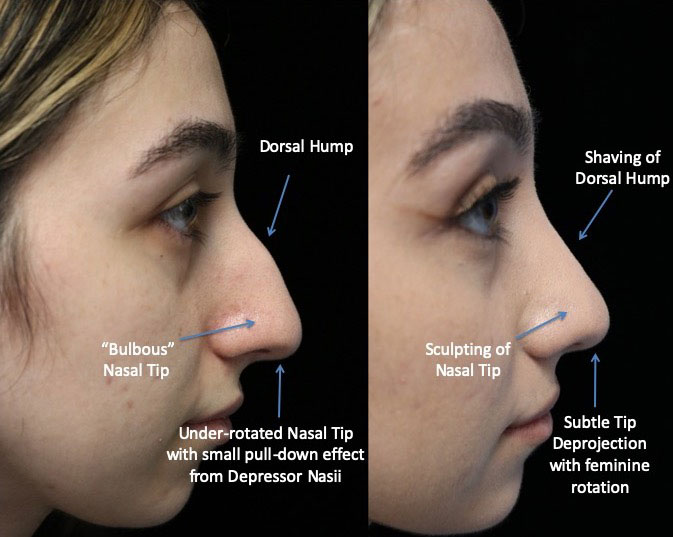 A female patient after a dorsal hump rhinoplasty