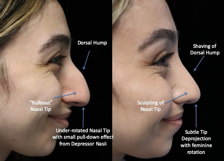 dorsal hump removal before and after photo of a woman