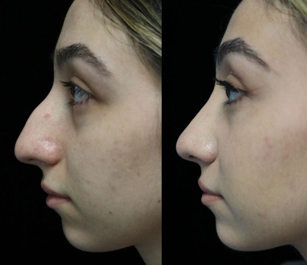 Before and after photo of a female patient who underwent a dorsal hump rhinoplasty