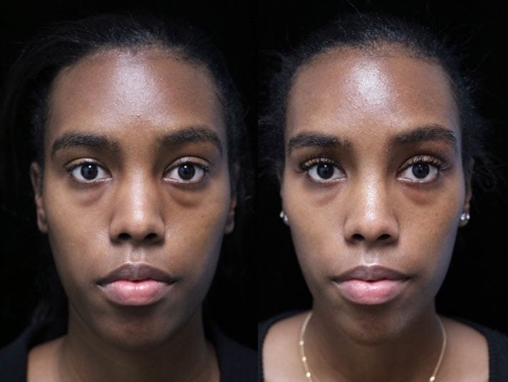Before photos of a woman who will undergo a bulbous nose tip reduction