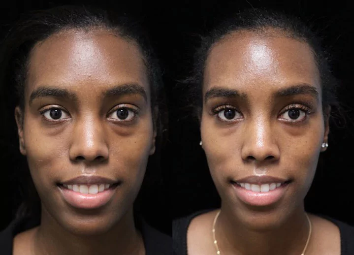 Before and after photo of a female patient with wide nasal bones who underwent a wide nose rhinoplasty
