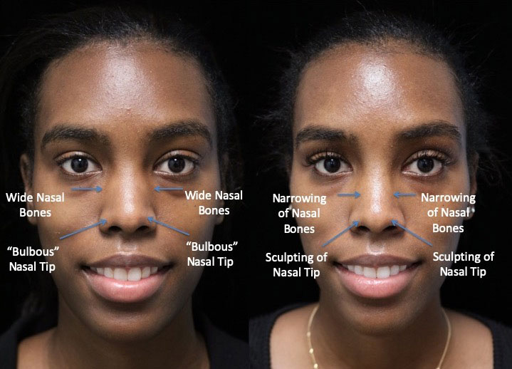 Before photos of a woman with a bulbous nose tip who will undergo a bulbous nose reshaping