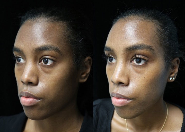 Before photos of a woman slightly facing left who will undergo a bulbous nose reshaping