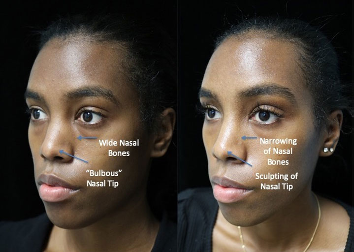 Before photos of a woman with a bulbous nasal tip slightly facing left