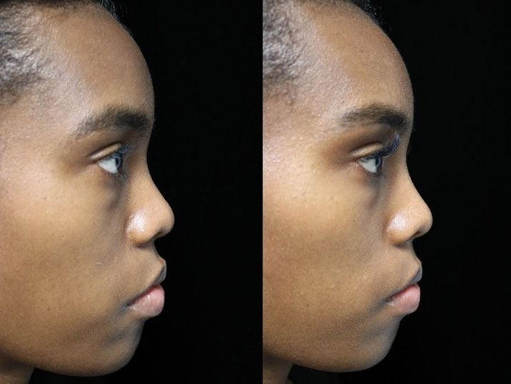 Before photos of a woman who will undergo a nose tip surgery