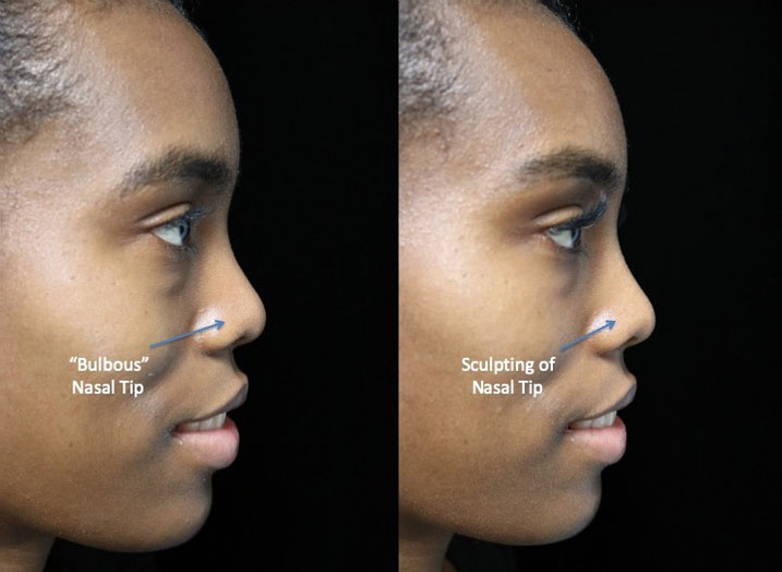 A woman with a bulbous nasal tip facing left