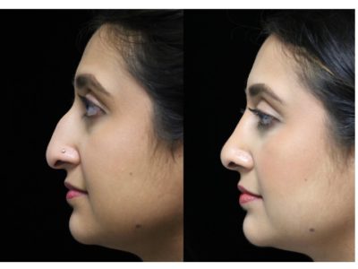 risks associated with closed rhinoplasty