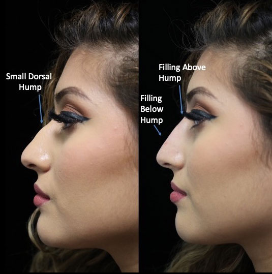 a non surgical nose job patient facing right on a before and after close up photo
