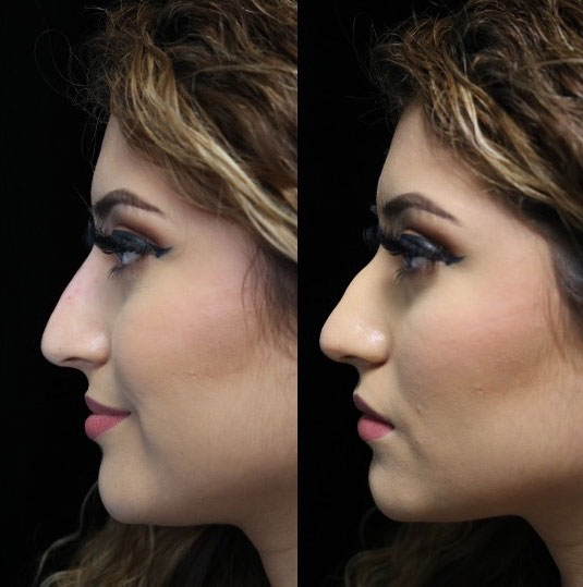 a non surgical nose job patient facing right on a before and after close up photo